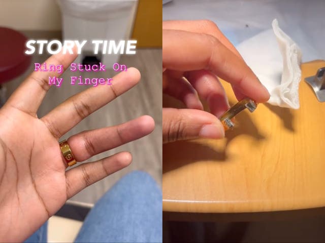 <p>Woman goes to three emergency rooms to get ring off finger but has plans to buy the same one again</p>