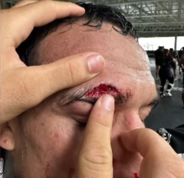 Oliveira shows the cut that derailed his planned rematch with Makhachev