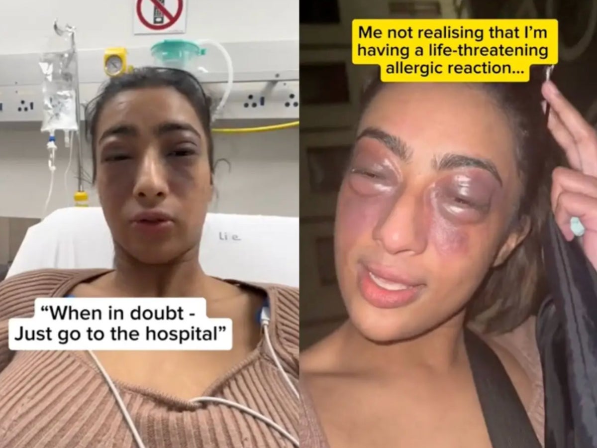 Influencer filmed ‘life-threatening’ allergic reaction to warn followers
