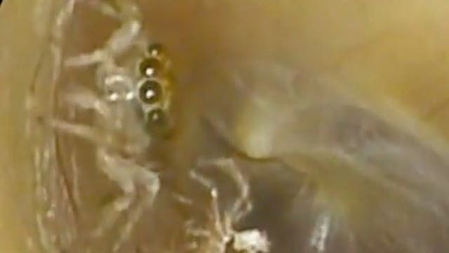 <p>Moment doctor discovers tiny spider living deep inside woman’s ear.</p>