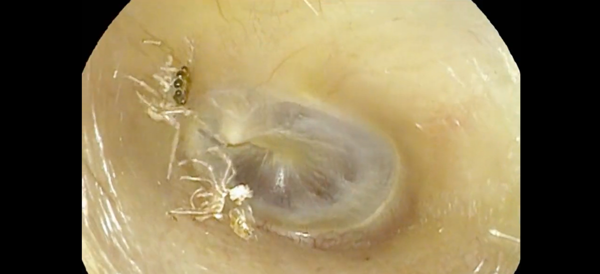A woman kept hearing unexplained clicking and rustling sounds. Doctors found a spider in her ear