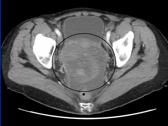 A large ovarian cancer tumour as seen on a CT scan