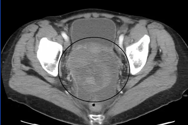 <p>A large ovarian cancer tumour as seen on a CT scan</p>