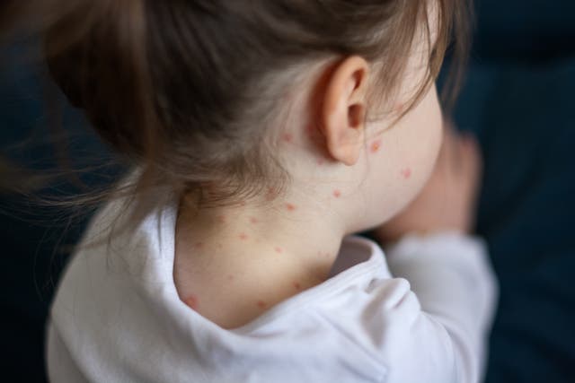 <p>Chickenpox is a common childhood illness and is usually mild</p>