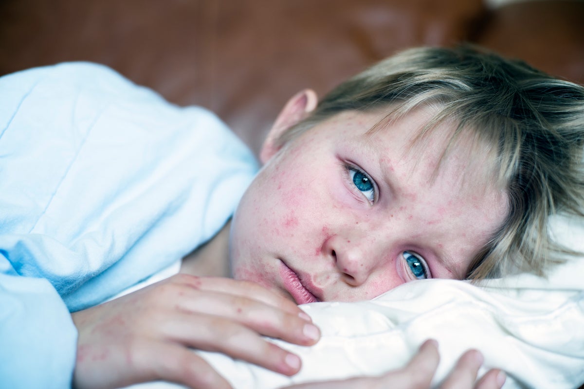 London overtakes West Midlands in measles cases as fears of an outbreak grow