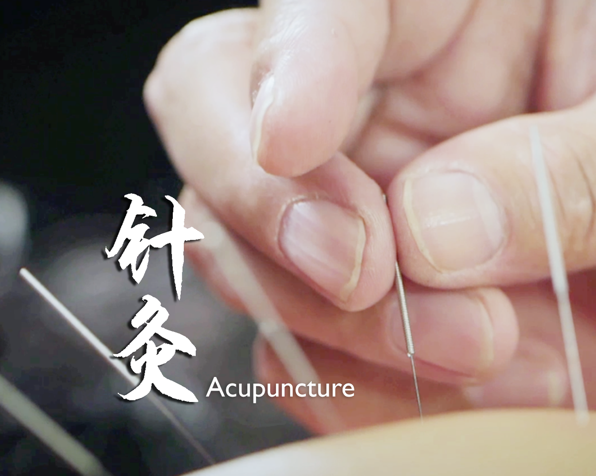 Living Heritage: Acupuncture - Vimarsana News