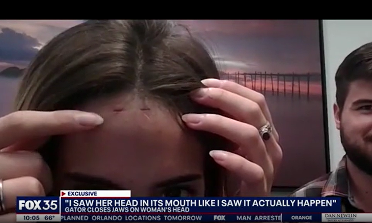 Florida woman bitten on head by nine-foot alligator - Vimarsana News