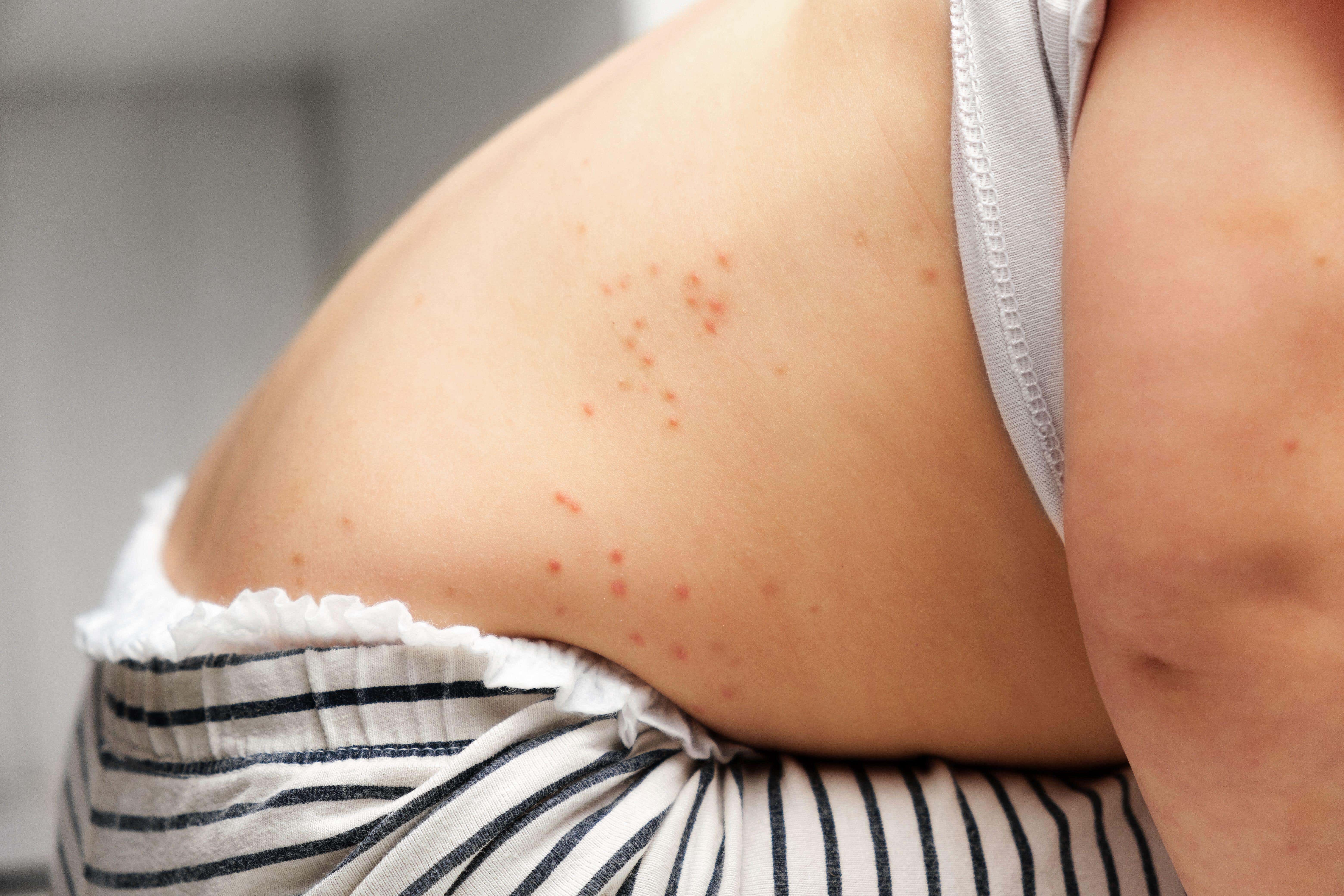 The chickenpox vaccine will help prevent cases of illness, the Joint Committee on Vaccination and Immunisation said