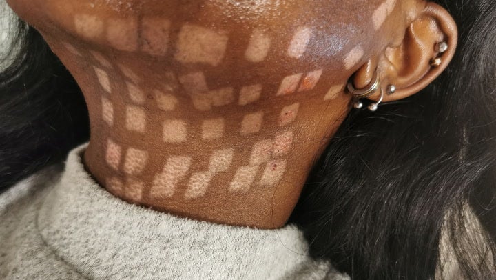 Woman suffers chessboard burns after botched hair removal treatment