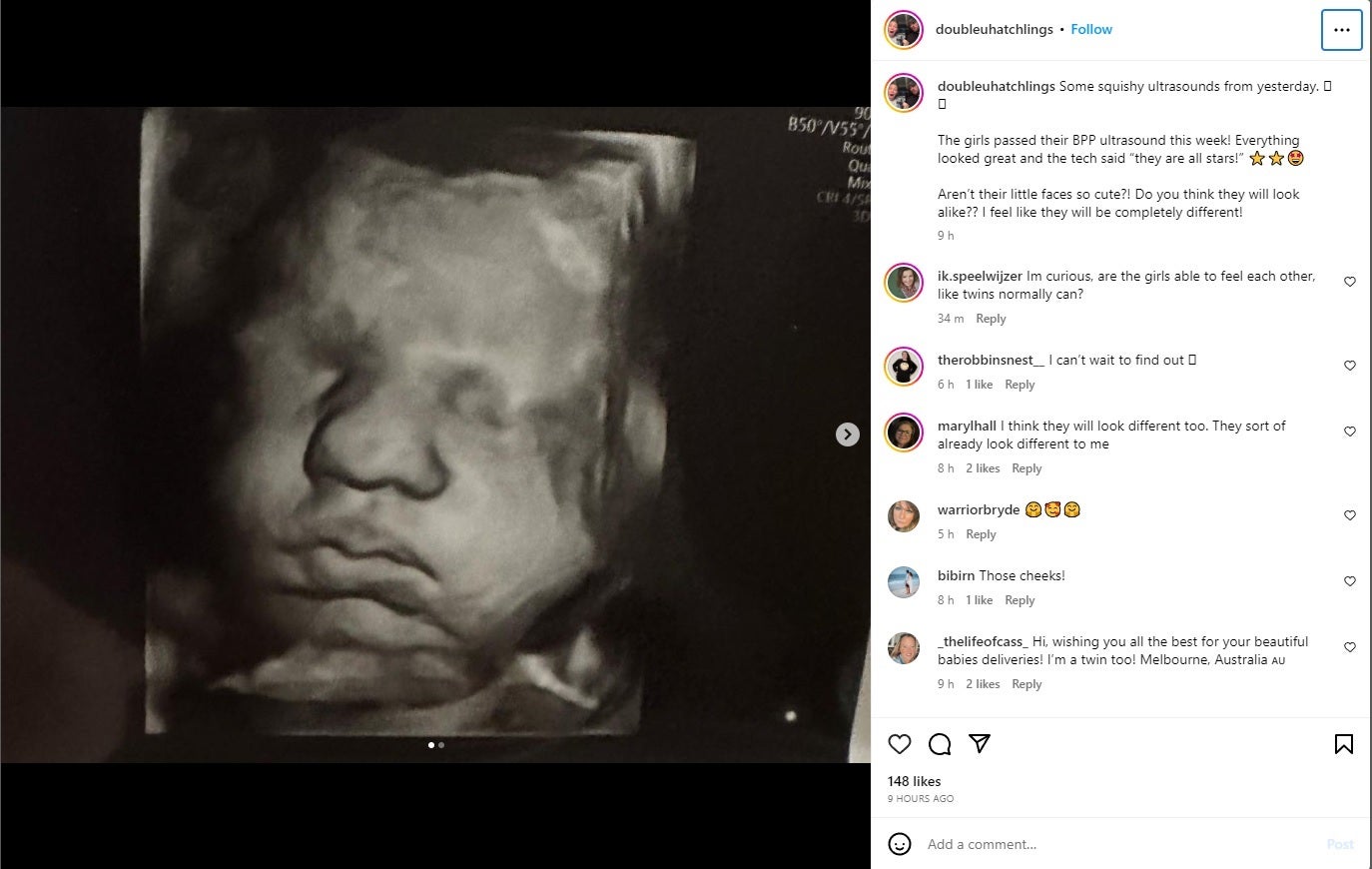 Kelsey Hatcher documents her extremely rare case of having two uteruses and being pregnant in both on Instagram