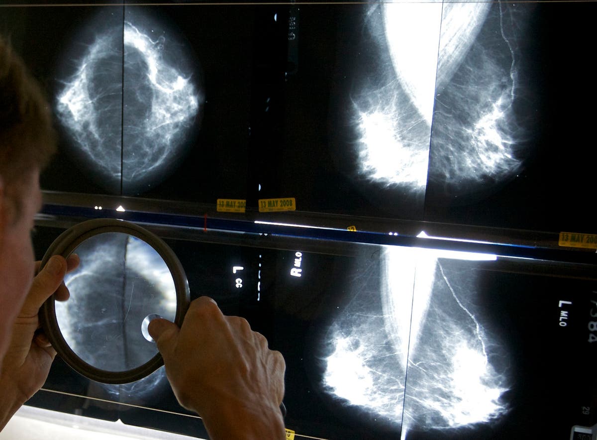 Преживелите рак на гърдата може да не се нуждаят от толкова много мамографии след операция, показва проучване в Обединеното кралство