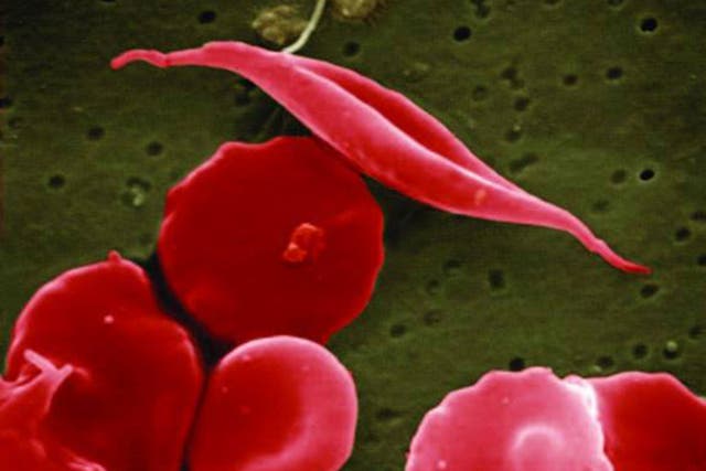 <p>Sickle cell disease gets its name from the process of healthy, oxygenated, O-shaped red blood cells losing oxygen via an abnormal haemoglobin protein, causing the cells to turn C-shaped, resembling a farm tool called a sickle</p>