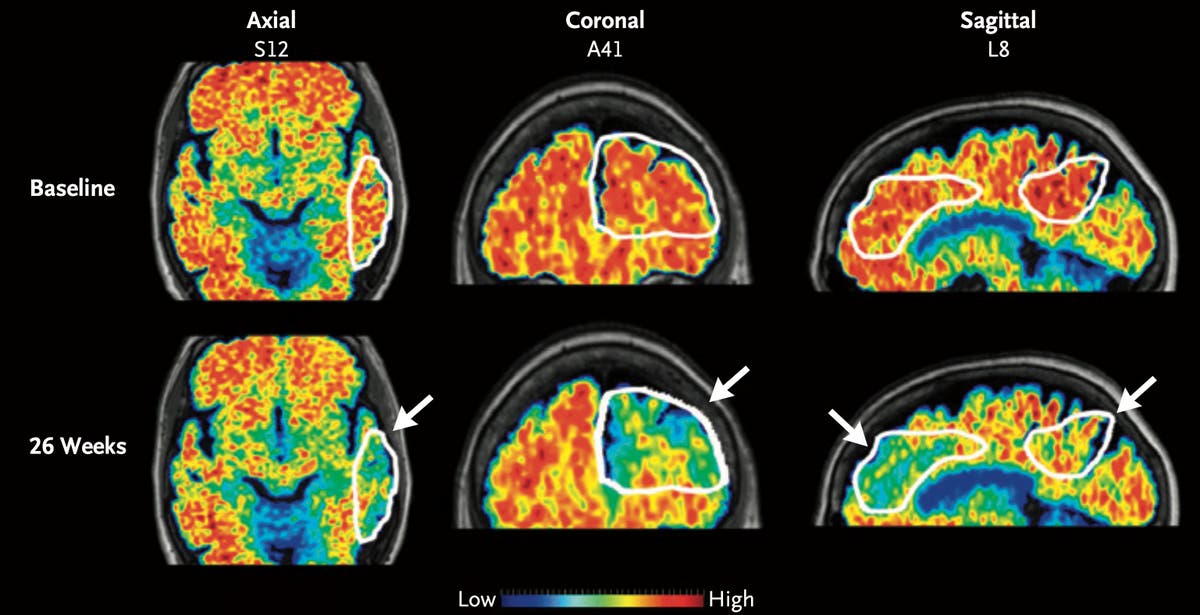 Лекарствата за Алцхаймер могат да навлязат в мозъка по-бързо с нов ултразвуков инструмент, показва проучване