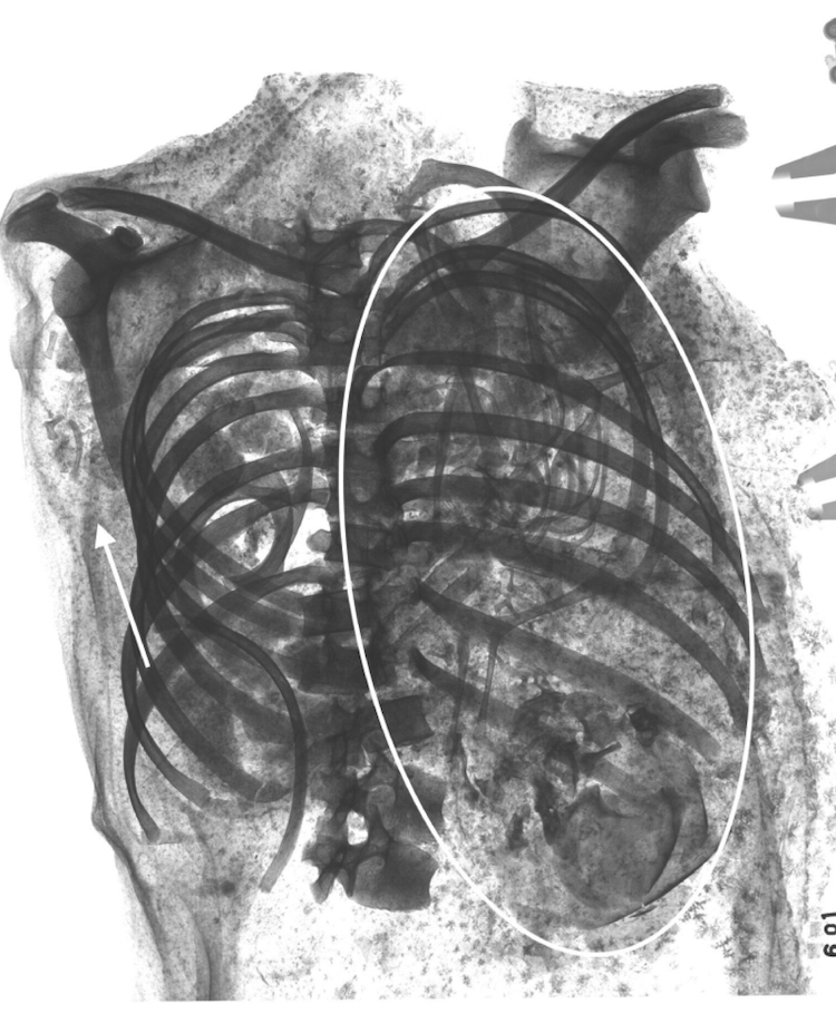 X-ray of chest cavity of female mummy