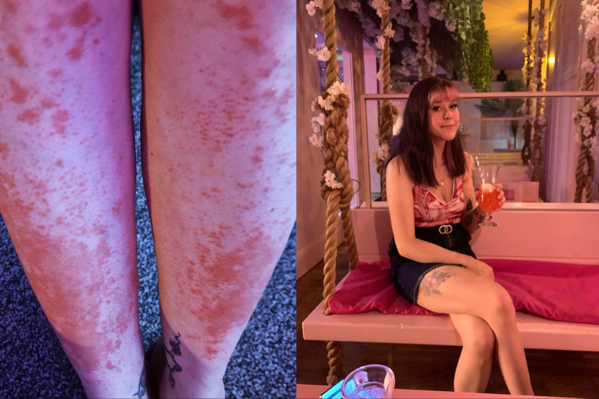 Mum finds miracle cure to eczema nightmare thanks to farmyard ingredient 