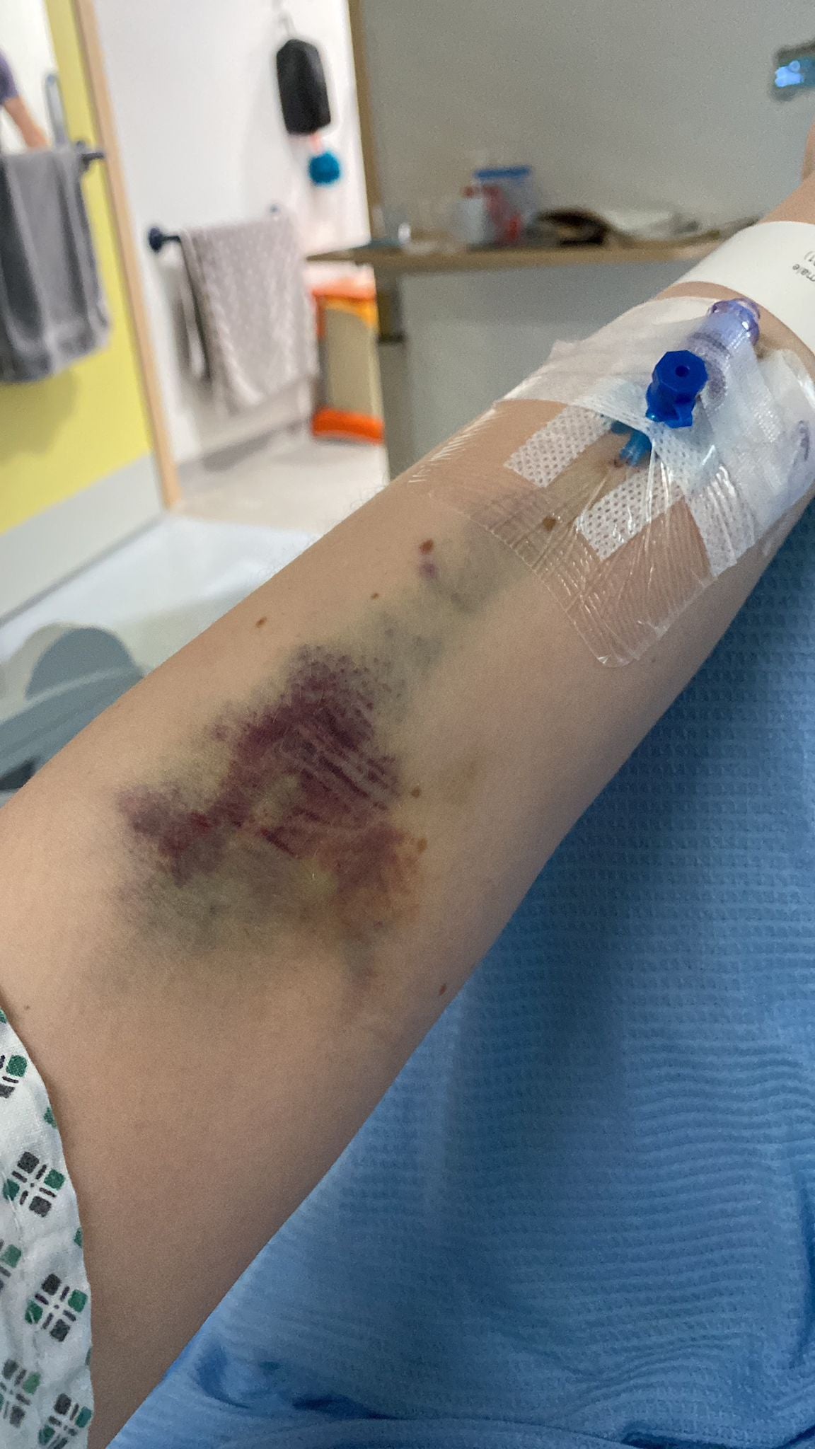 Elizabeth showing the bruising on her arm as a result of her treatments