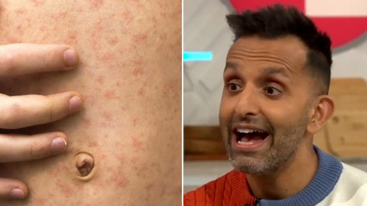 <p>Doctor shares key measles signs and symptoms to look out for as UK cases surge.</p>