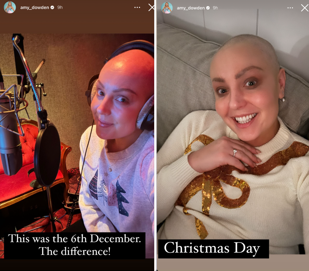 Dowden revealed the hair she had lost through chemotherapy has started growing back