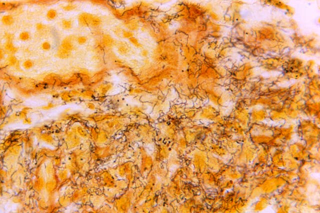 <p>This 1966 microscope photo made available by the Centers for Disease Control and Prevention shows a tissue sample with the presence of numerous, corkscrew-shaped, darkly-stained, Treponema pallidum spirochetes, the bacterium responsible for causing syphilis</p>