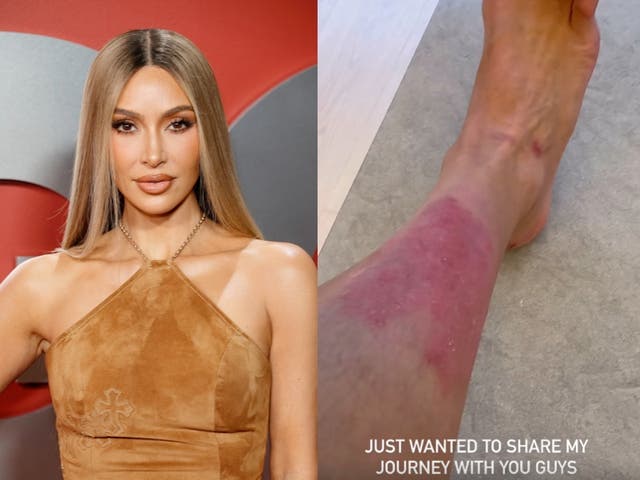 <p>Kim Kardashian 43, took to her Instagram Story to share new videos of the psoriasis flareup on her leg</p>