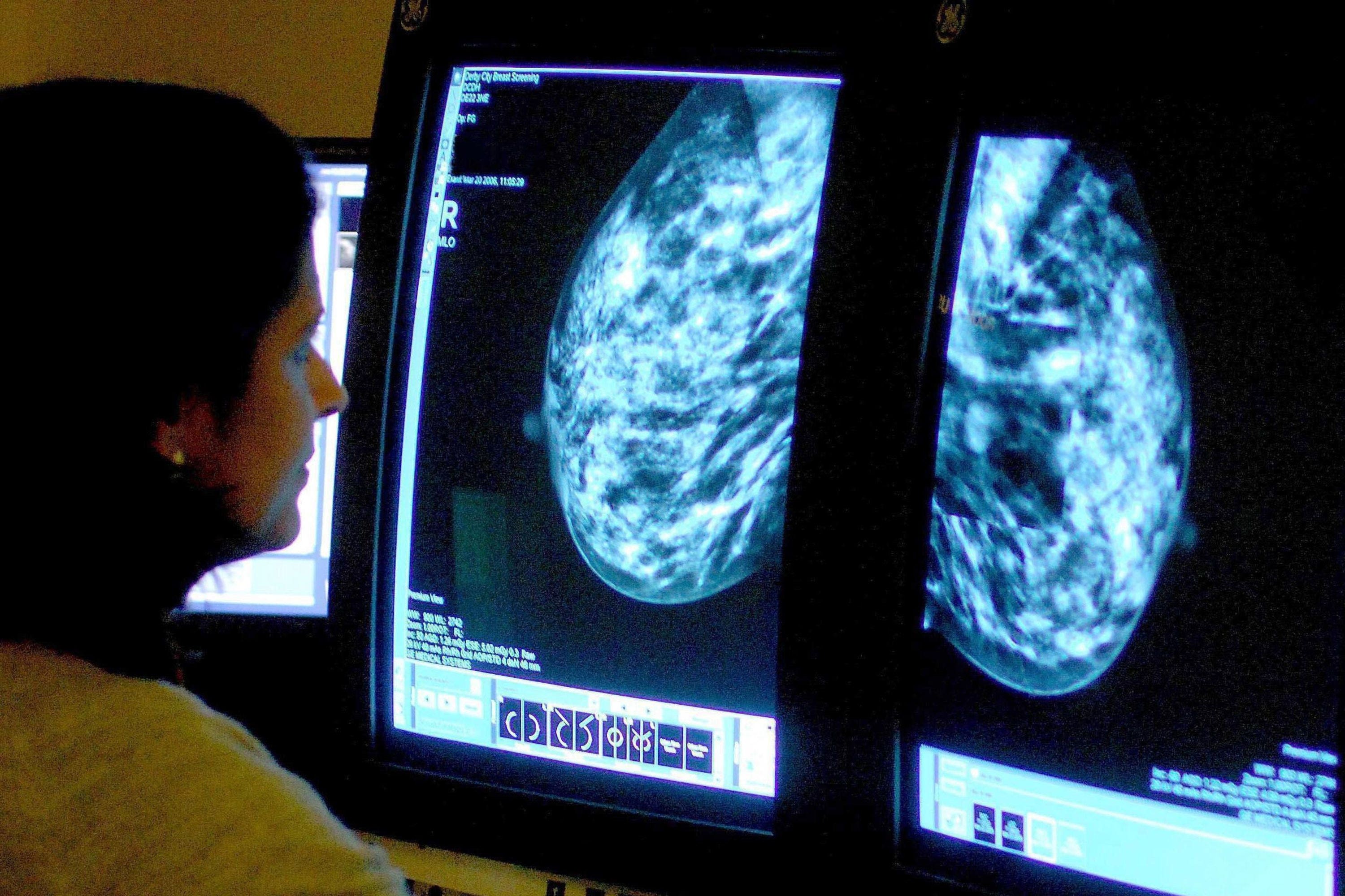 Cancer cases are predicted to soar in the coming years, according to new analysis (Rui Vieira/PA)