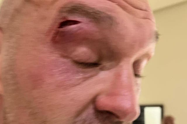 <p>The cut that has ruled Tyson Fury out of his fight with Oleksandr Usyk</p>