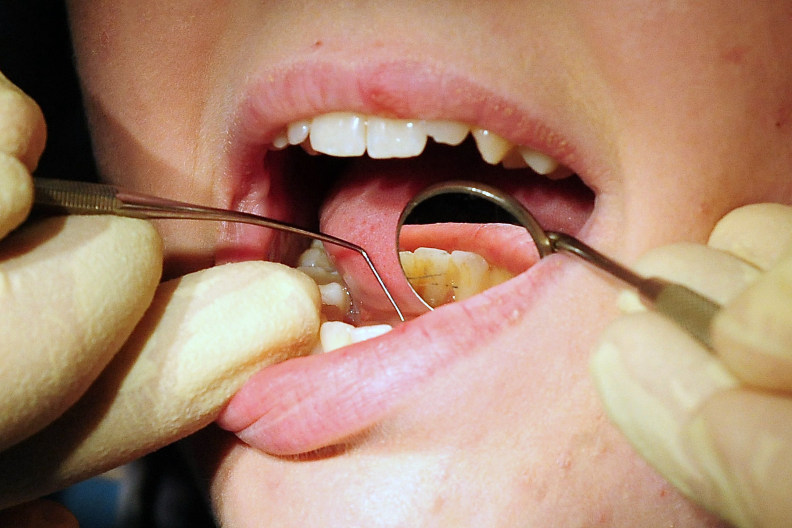 Thousands of children were admitted to hospital with tooth decay last year amid a surge in extractions (Rui Vieira/PA)