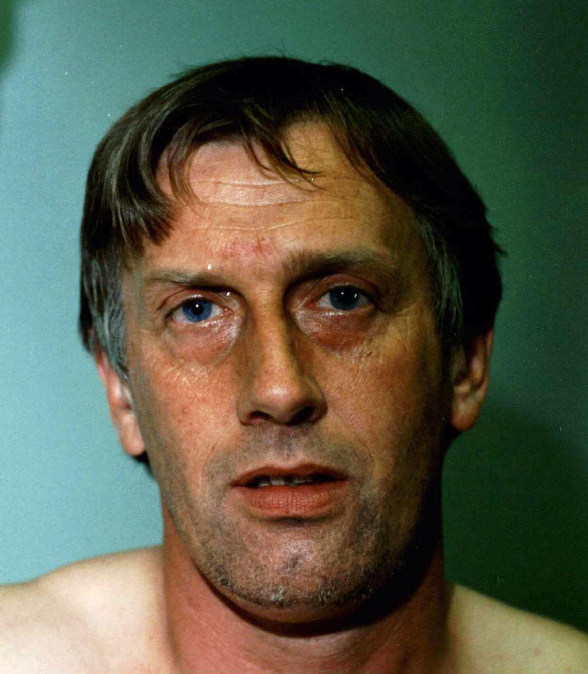 Whiting was left with a six-inch scar on his right cheek after he was attacked with a razor in 2002