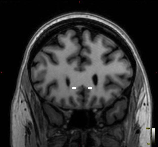 <p>This brain scan image provided by Mount Sinai in 2024 shows the targeted sites for electrodes implanted in Emily’s head </p>