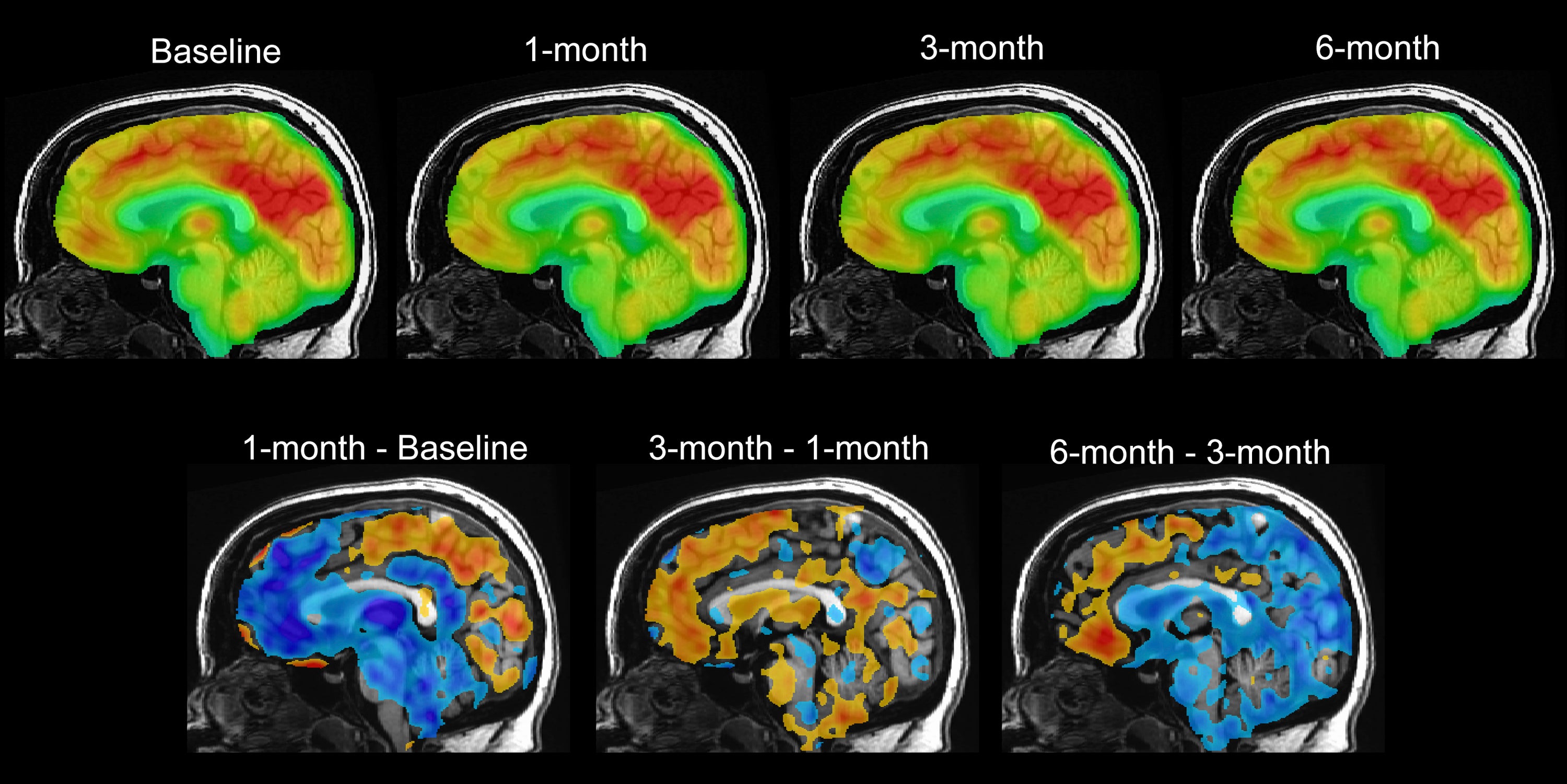 This series of PET brain scan images provided by Mount Sinai in 2024 shows changes in patient Emily Hollenbeck