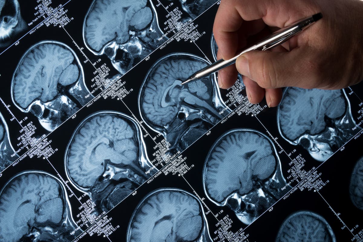 More people could soon be diagnosed with ‘stage one’ Alzheimer’s – but what are the signs?