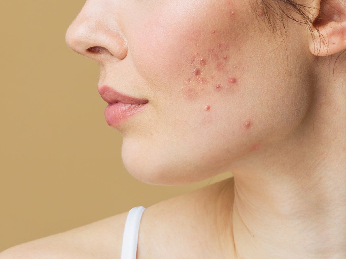 Is your acne treatment safe? Cancer-causing chemical found in Proactiv, Clearasil and more