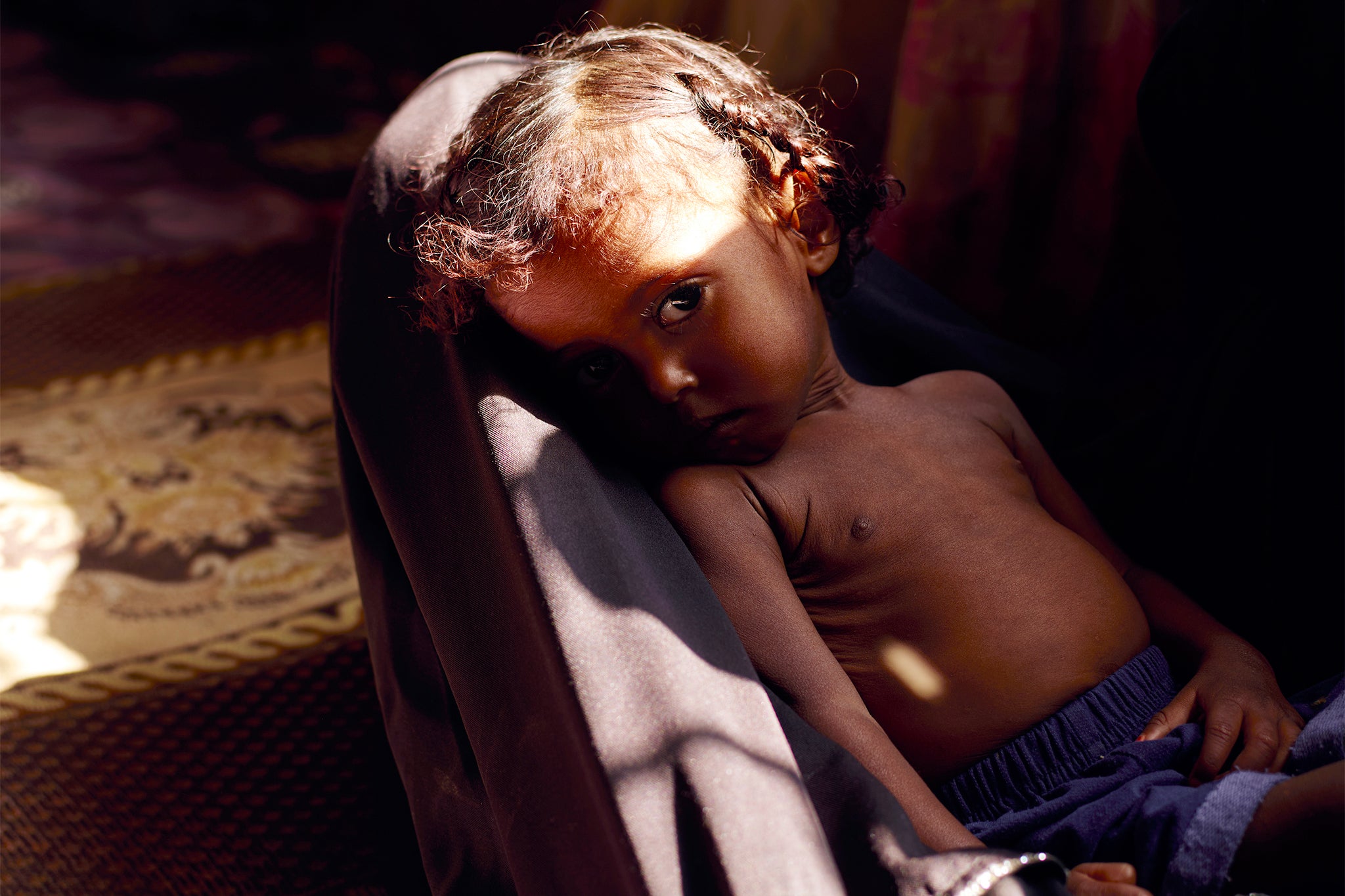 Riam, who was diagnosed with severe malnutrition more than 10 months ago. She is one of the 2.2 million children under five, identified by WFP, as being acutely malnourished in Yemen.