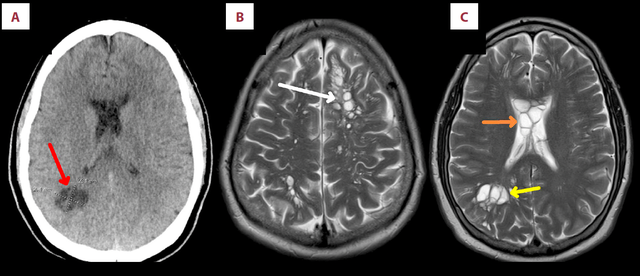<p>Brain scan showing man had many tapeworm larvae growing in different parts of his brain</p>
