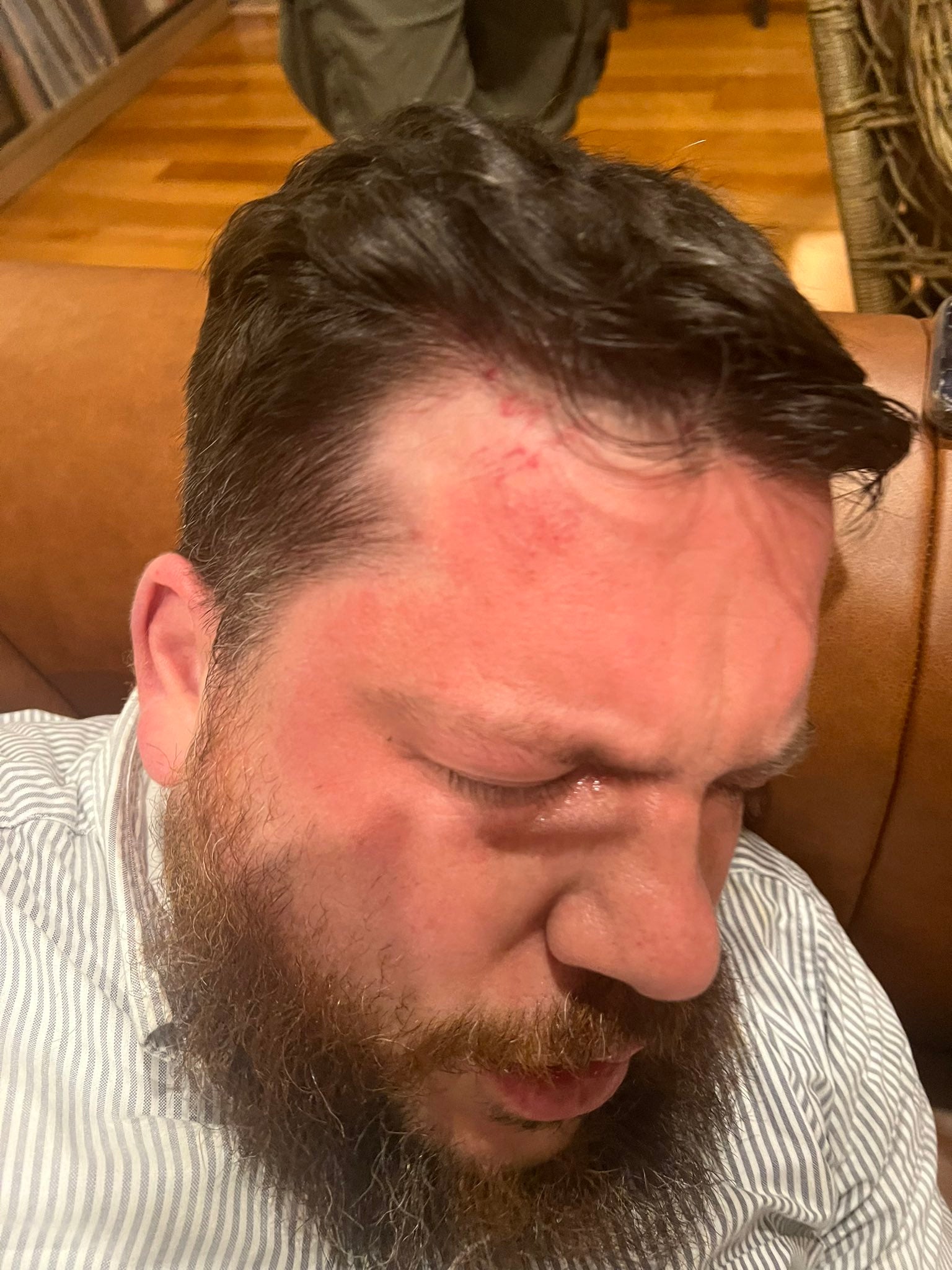 Leonid Volkov's wounds after he was attacked outside his home in Vilnius