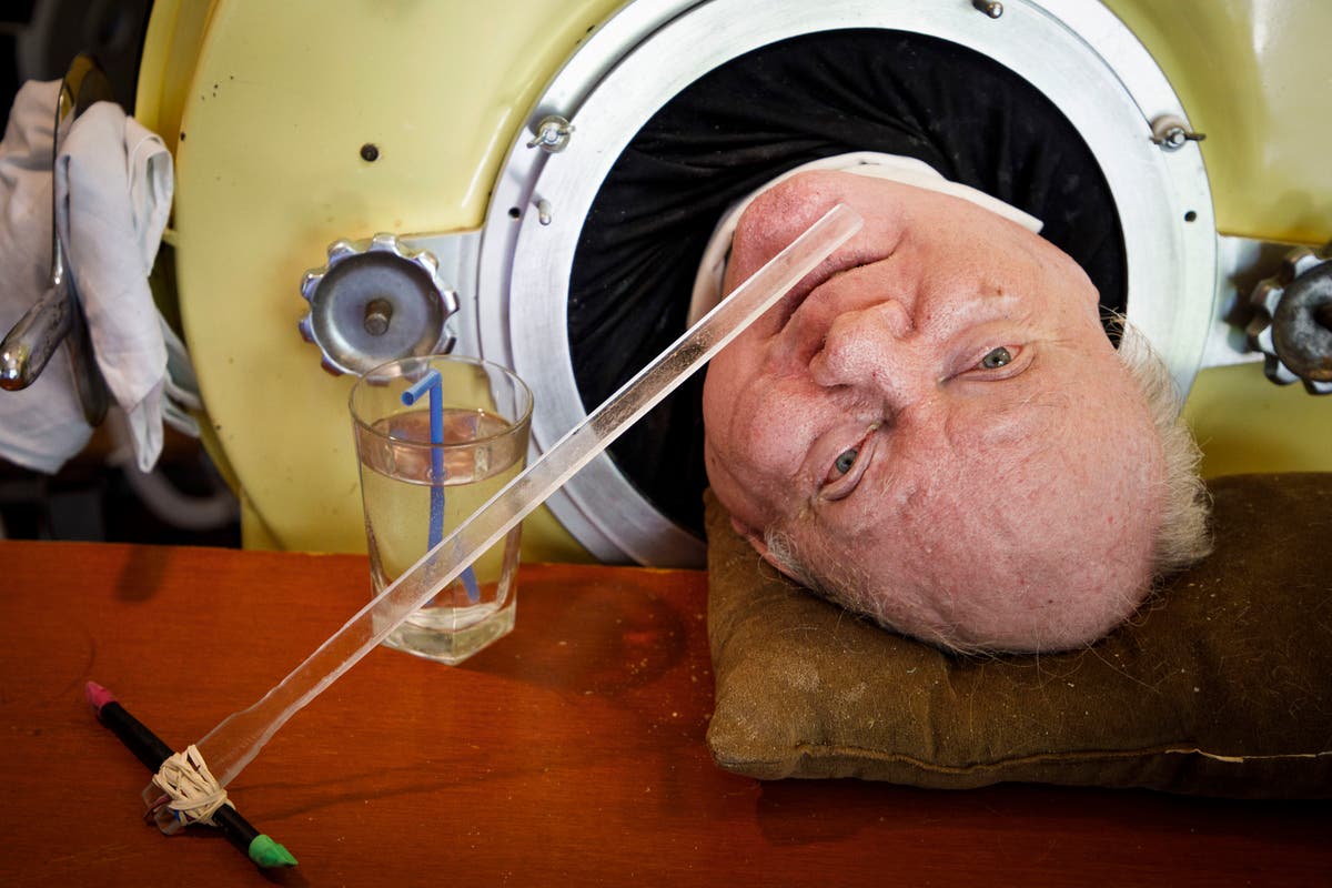 Texas man who used an iron lung for decades after contracting polio as a child dies at 78