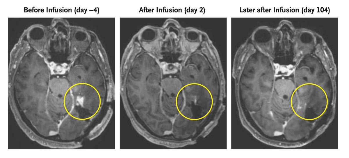 A new strategy to attack aggressive brain cancer shrank tumors in two early tests