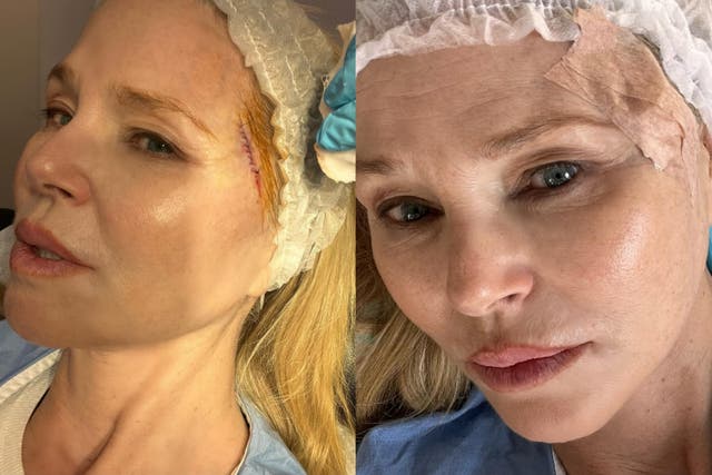 <p>Christie Brinkley shares surgery pictures</p>