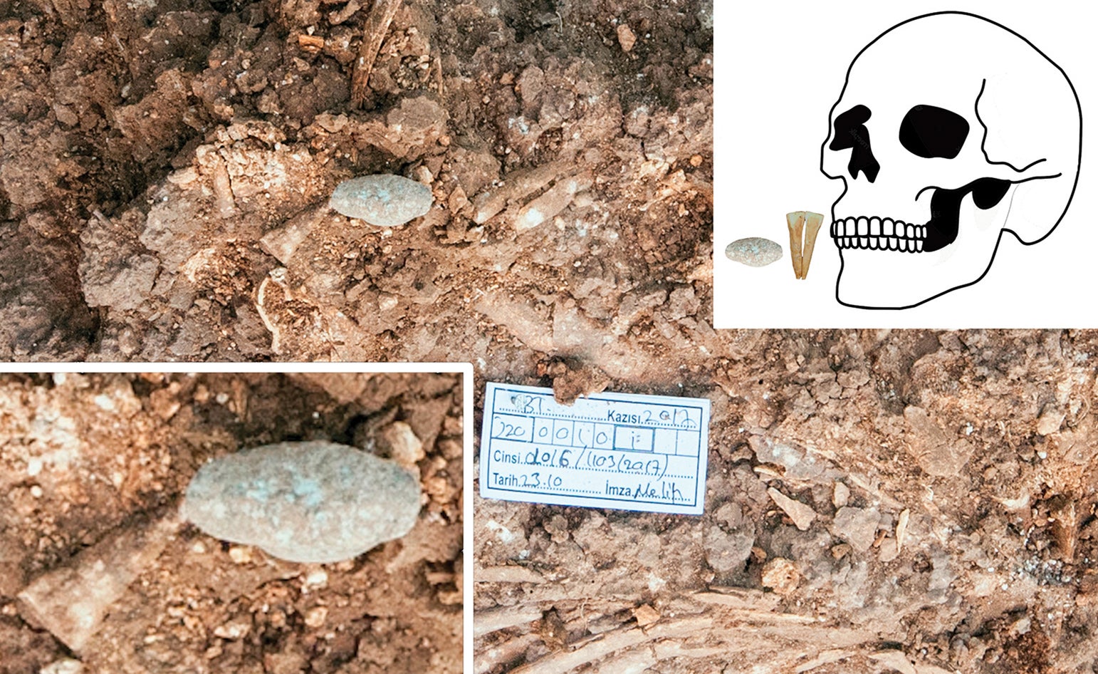 A type-5 labret (lip piercing) example from inside the mouth (inset illustration). (photographs from the Boncuklu Tarla Excavation Archive, figure by authors).