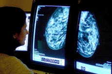 Breast cancer survivors at significant risk of developing entirely new cancers