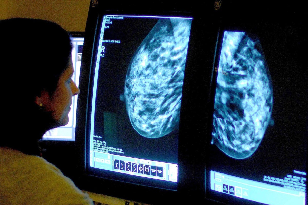 AI-supported breast cancer screenings result in fewer aggressive cases
