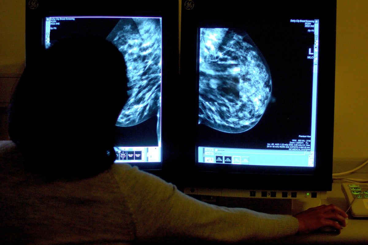 Drugs breakthrough could help those with faulty gene avoid breast cancer surgery