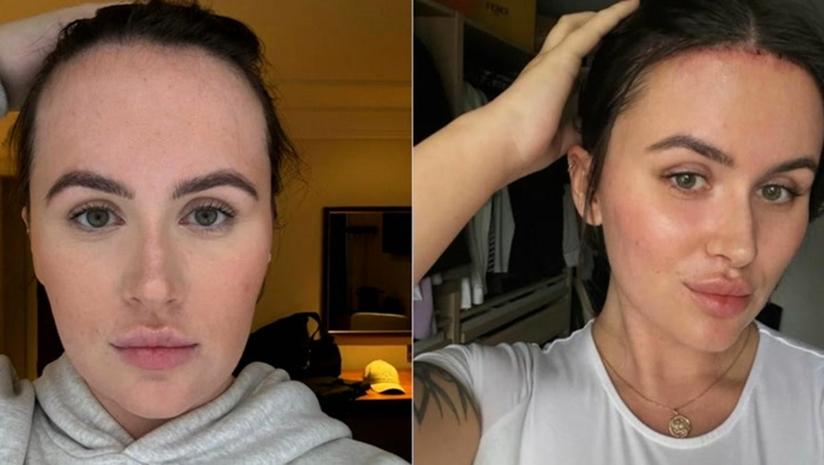 Woman who spent £9,000 getting forehead reduction shows off results