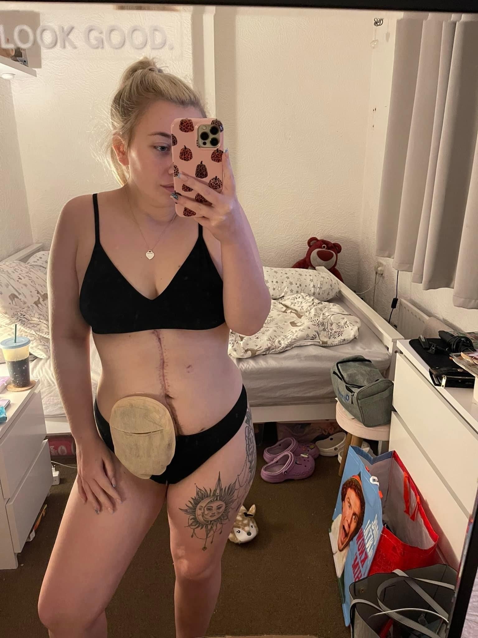 Emma had a temporary stoma while undergoing treatment