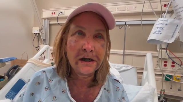 <p>Woman’s mouth wired shut after Venice attack.</p>