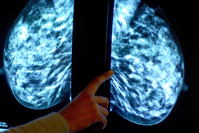 A report warned of the social and emotional impacts of breast cancer on patients (Rui Vieira/PA)