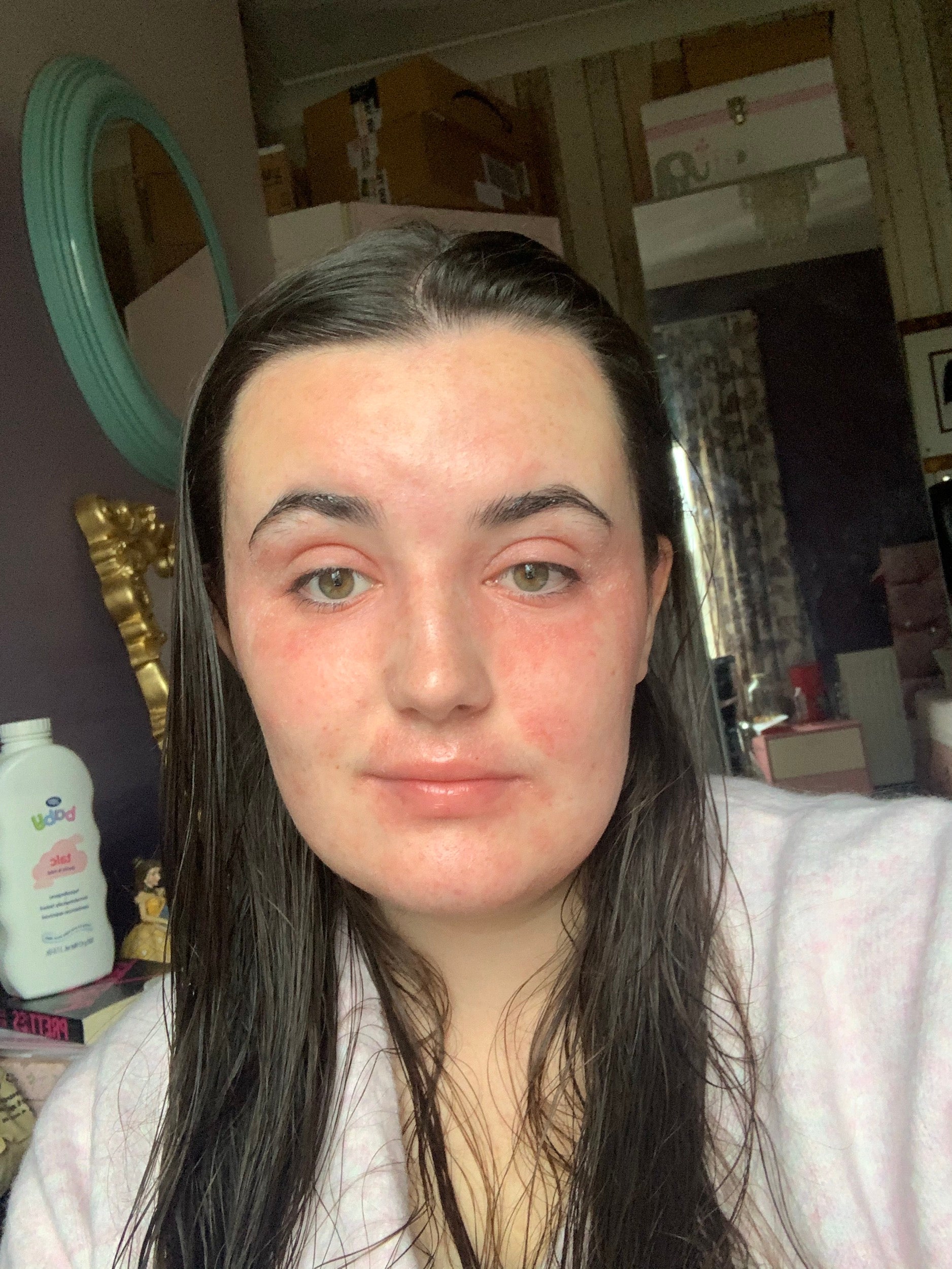 Megan has had eczema since she was a baby
