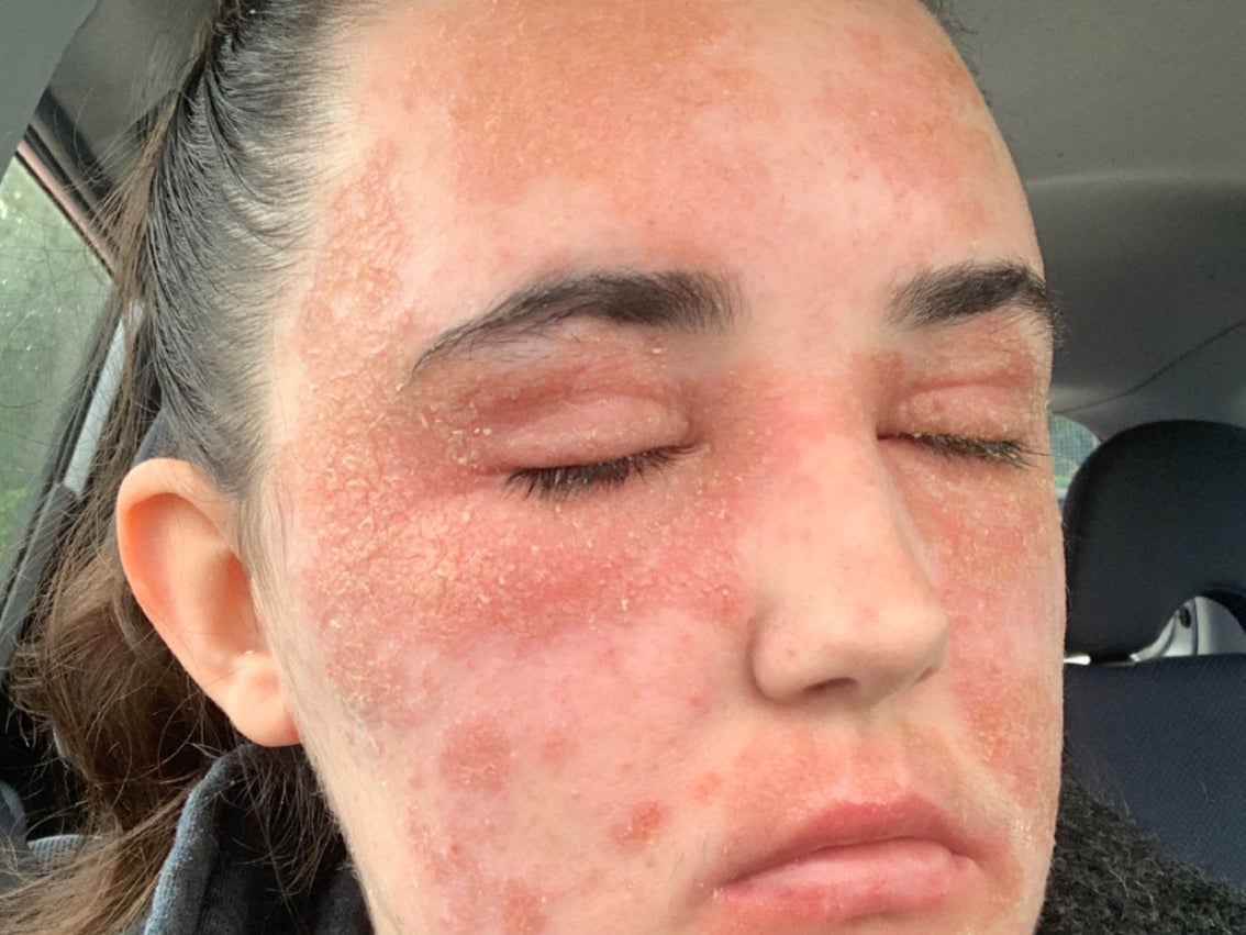 The eczema was so bad that it sealed her eyes and mouth shut (Collect/PA Real Life)