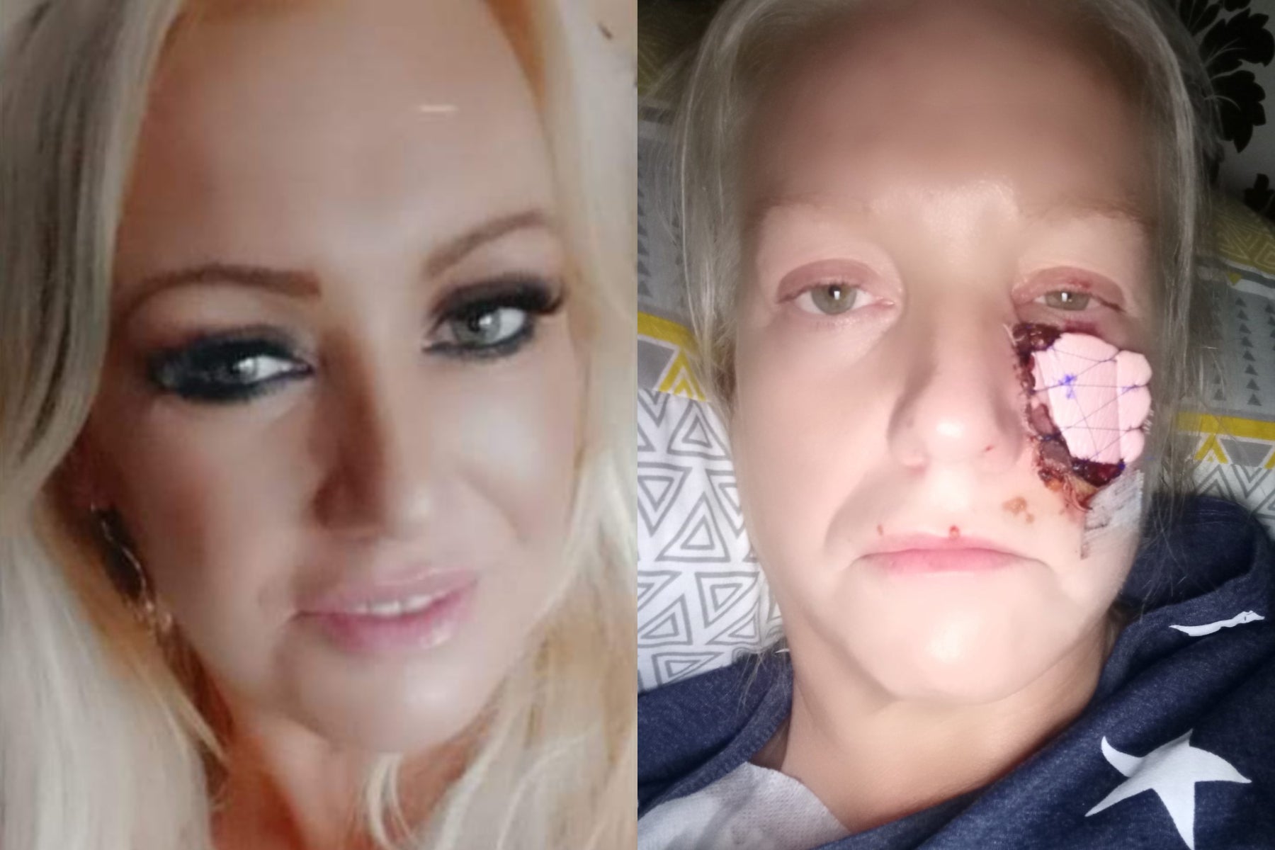 Kelly Allen, 45, from Swansea, had part of her cheek ripped off when she was attacked without warning by a friend's pet dachshund (Collect/PA Real Life)