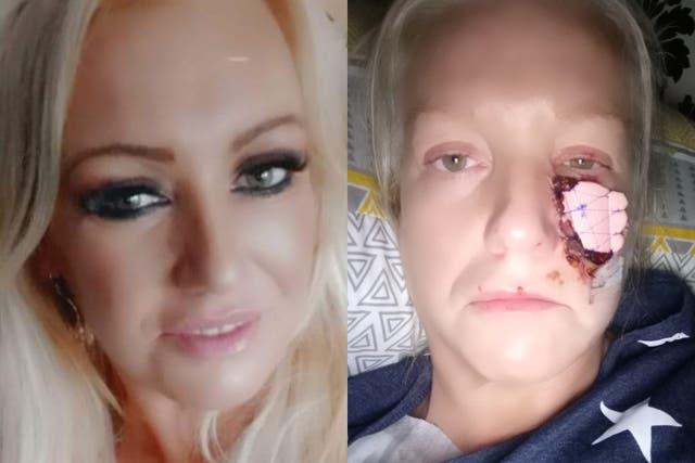 <p>Kelly Allen, 45, from Swansea, had part of her cheek ripped off when she was attacked without warning by a friend's pet dachshund (Collect/PA Real Life)</p>